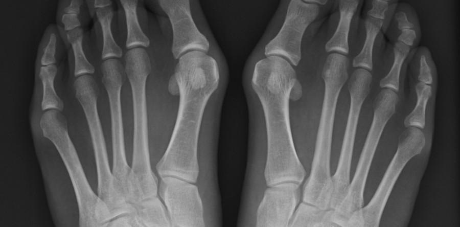 Alluce valgo – vergiate varese