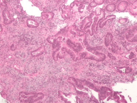 Carcinoma del retto Varese Vergiate – Dott. Tessera