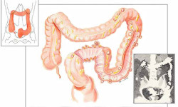 Diverticoli del Colon Dr. Tessera