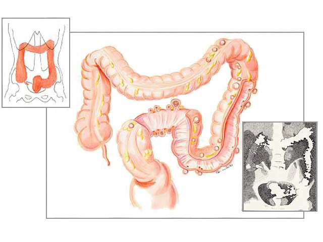 Diverticoli del Colon Dr. Tessera