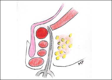 Fistole Anali Varese Vergiate – Dott. Tessera