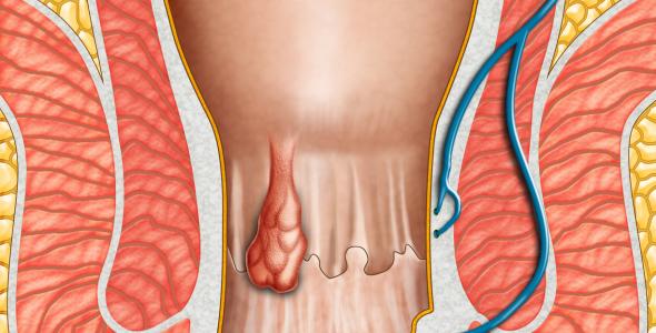 Emorroidi Dr.Tessera Vergiate Varese