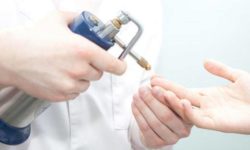 crioterapia verruche – vergiate varese