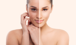 Peeling con Acido Salicidico – Vergiate Varese