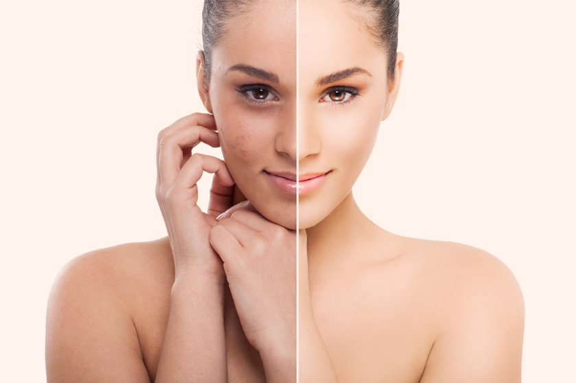 Peeling con Acido Salicidico – Vergiate Varese