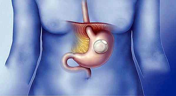 PALLONCINO INTRAGASTRICO CONTRO L’OBESITÀ