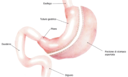 SLEEVE GASTRECTOMY CHIRURGIA BARIATRICA CONTRO L’OBESITA’