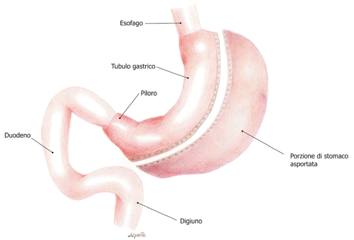 SLEEVE GASTRECTOMY CHIRURGIA BARIATRICA CONTRO L’OBESITA’