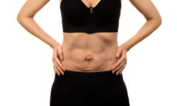 Diastasi addominale: definizione, cause, sintomi e chirurgia