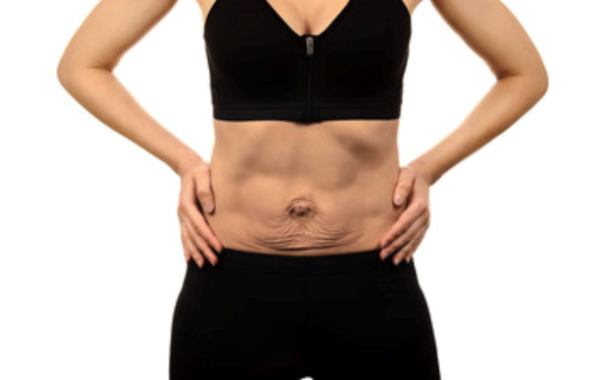 Diastasi addominale: definizione, cause, sintomi e chirurgia