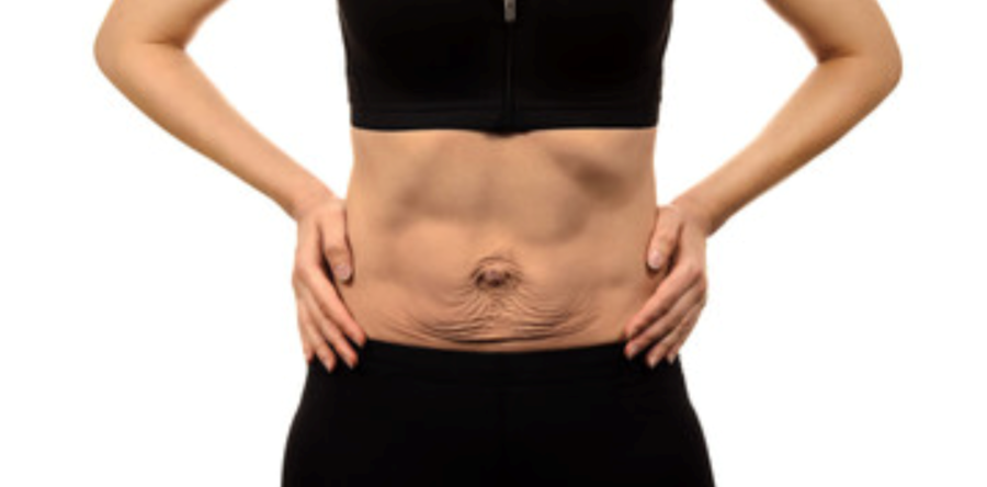Diastasi addominale: definizione, cause, sintomi e chirurgia