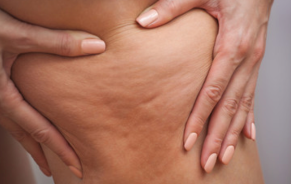 Pelle a buccia d’arancia: come combattere la cellulite