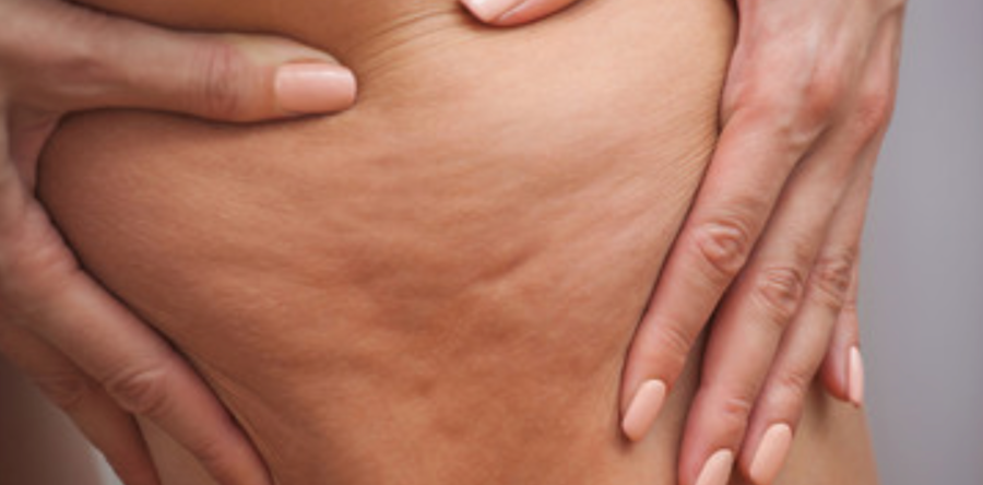 Pelle a buccia d’arancia: come combattere la cellulite