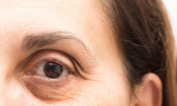 Rimedi Occhiaie con la Medicina Estetica