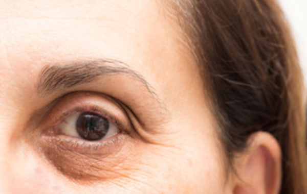 Rimedi Occhiaie con la Medicina Estetica