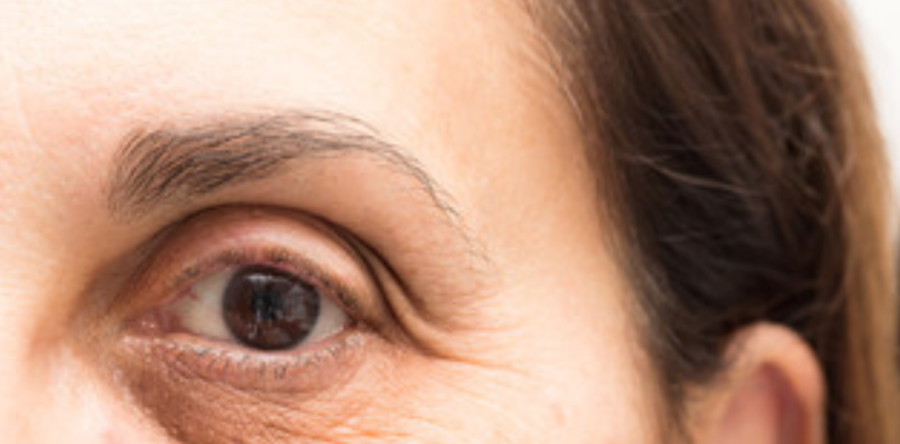 Rimedi Occhiaie con la Medicina Estetica