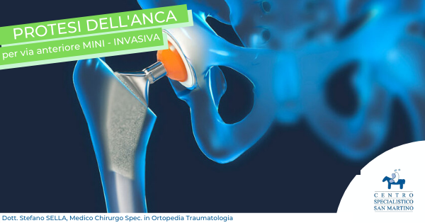PROTESI ALL’ANCA PER VIA ANTERIORE MINI-INVASIVA